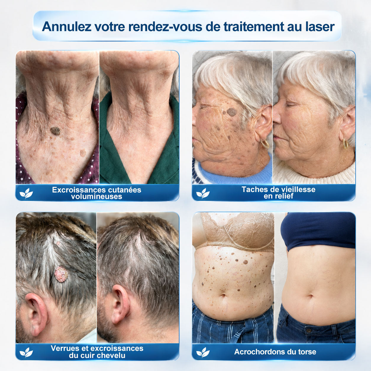 Boutique officielle de la marque 𝐏i𝐜𝐝o® 💐💖7 Jours Effaceur de taches et d’excroissances cutanées(Zéro douleur, zéro cicatrice – Roller)