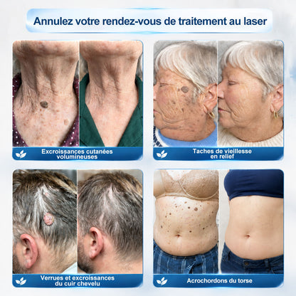 Boutique officielle de la marque 𝐏i𝐜𝐝o® 💐💖7 Jours Effaceur de taches et d’excroissances cutanées(Zéro douleur, zéro cicatrice – Roller)
