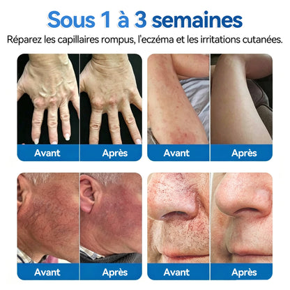 🍁💖𝐅𝐥𝐨𝐫𝐢𝐬𝐦𝐚®𝐑é𝐩𝐚𝐫𝐚𝐭𝐢𝐨𝐧 𝐃𝐞𝐬 𝐕𝐞𝐢𝐧𝐞𝐬 𝐑𝐨𝐮𝐥𝐞𝐚𝐮 𝐃𝐞 𝐏𝐚𝐭𝐜𝐡𝐬 𝐀𝐯𝐞𝐜 𝐌𝐢𝐜𝐫𝐨-𝐚𝐢𝐠𝐮𝐢𝐥𝐥𝐞𝐬⚡Soulagement immédiat, résultats à long terme