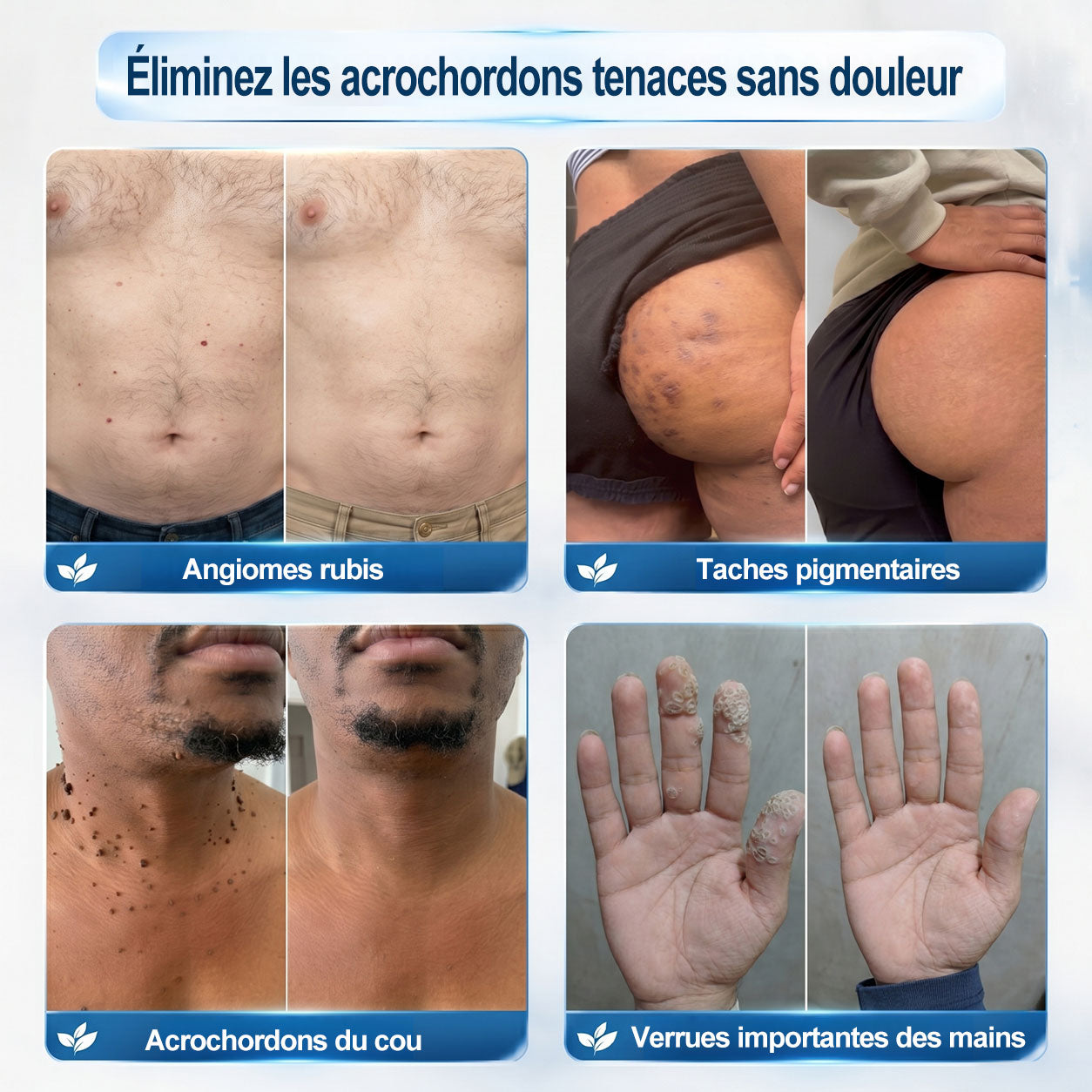 Boutique officielle de la marque 𝐏i𝐜𝐝o® 💐💖7 Jours Effaceur de taches et d’excroissances cutanées(Zéro douleur, zéro cicatrice – Roller)