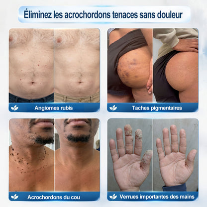 Boutique officielle de la marque 𝐏i𝐜𝐝o® 💐💖7 Jours Effaceur de taches et d’excroissances cutanées(Zéro douleur, zéro cicatrice – Roller)