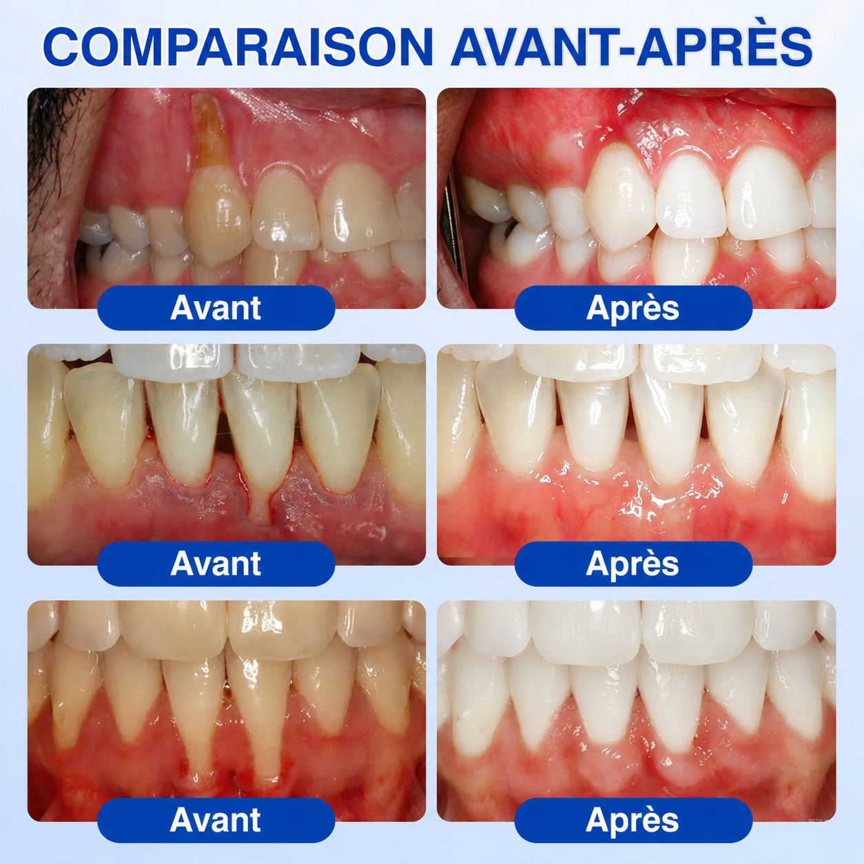 🍁💖 𝑮𝒍𝒊𝒎𝒎𝒆𝒓𝒍𝒚®🦷 𝑮𝒖𝒎𝑹𝒆𝒗𝒊𝒗𝒆 𝑮𝒆𝒍 𝒅𝒆 𝑹é𝒑𝒂𝒓𝒂𝒕𝒊𝒐𝒏 𝑷𝒂𝒓𝒐𝒅𝒐𝒏𝒕𝒂𝒍𝒆