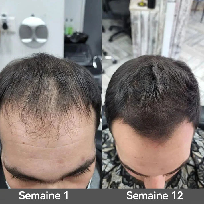 🌿👨‍⚕️ Boutique officielle française | 🔥𝐓𝐨𝐜𝐥𝐯𝐨®🍁💖𝐁𝐢𝐨𝐭𝐢𝐧𝐞 𝐑𝐨𝐦𝐚𝐫𝐢𝐧 𝐇𝐚𝐮𝐭𝐞𝐦𝐞𝐧𝐭 𝐄𝐟𝐟𝐢𝐜𝐚𝐜𝐞 𝐒é𝐫𝐮𝐦 𝐏𝐨𝐮𝐫 𝐋𝐚 𝐏𝐨𝐮𝐬𝐬𝐞 𝐃𝐞𝐬 𝐂𝐡𝐞𝐯𝐞𝐮𝐱 — (🔥 Offre à durée limitée, ⏳ Promotion du dernier jour : 50 % de réduction)