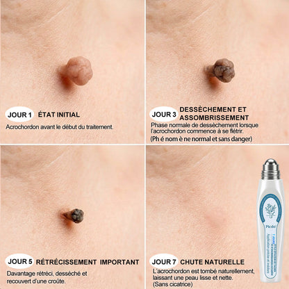 Boutique officielle de la marque 𝐏i𝐜𝐝o® 💐💖7 Jours Effaceur de taches et d’excroissances cutanées(Zéro douleur, zéro cicatrice – Roller)